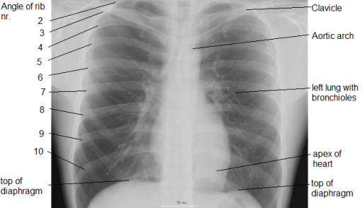 Chest_labeled